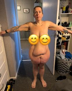 Woman's before-and-after weight loss photo; breasts are censored.