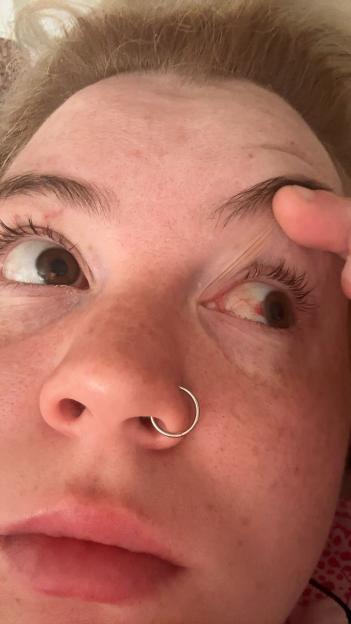Close-up of a person's eye showing signs of injury.