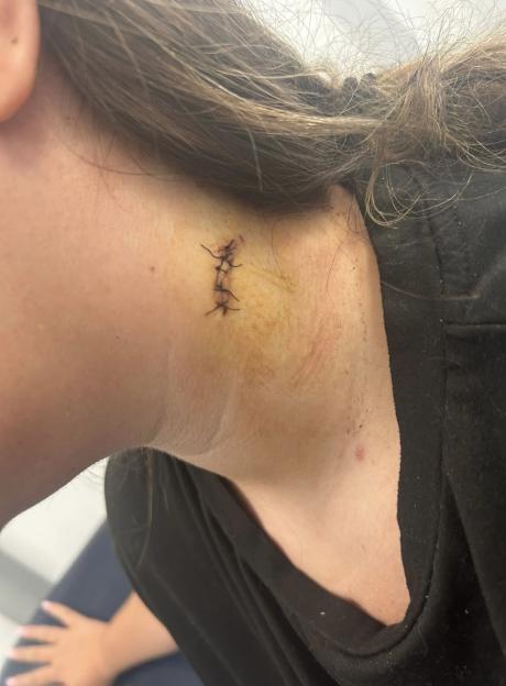 A close-up of a person's neck and ear, showing stitches on the back of the neck from a wound.