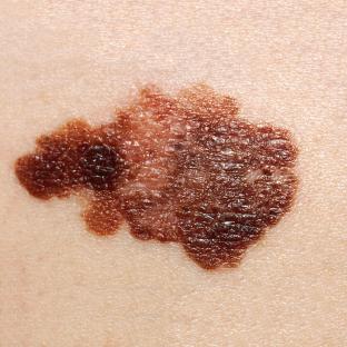 Close-up photograph of a melanoma.