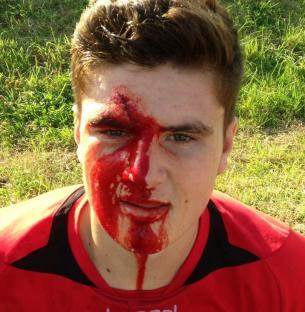 A young man with a bloody injury to his face.