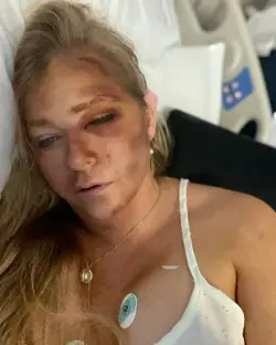 Woman in hospital bed with facial injuries.