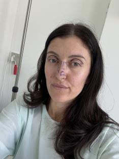 Woman with markings on her face before eyelid and nose surgery.