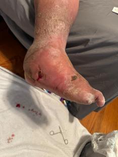 Infected foot wound after pedicure.