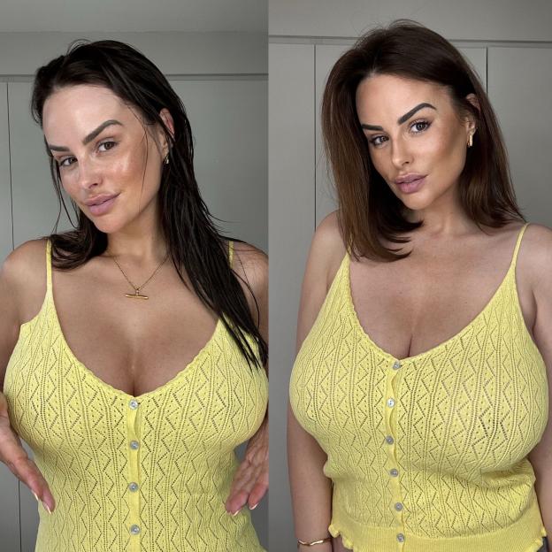 Before and after photos of a woman's breast reduction.