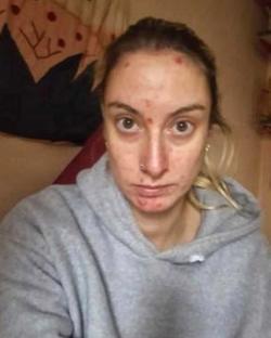 Woman with acne.