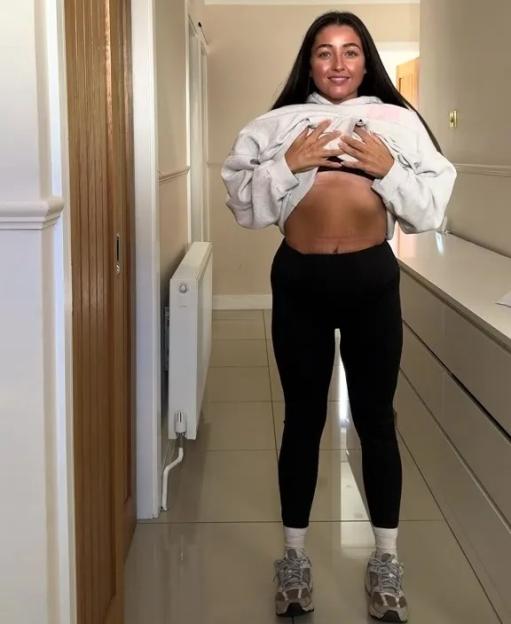 A young woman showing loose skin and stretch marks on her belly from weight loss.