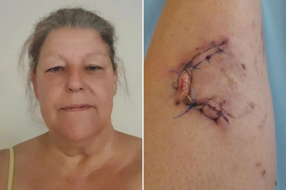 Woman mauled by XL Bully which ‘sunk its teeth into her leg’ leaving her ‘traumatised’