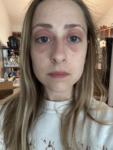 Woman with red eyes and skin irritation.