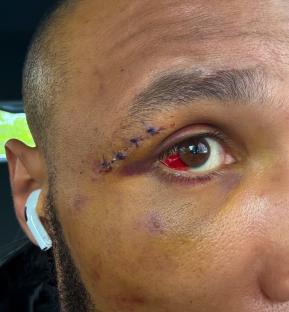 Close-up of Chris Eubank Jr.'s eye with stitches and bruising.