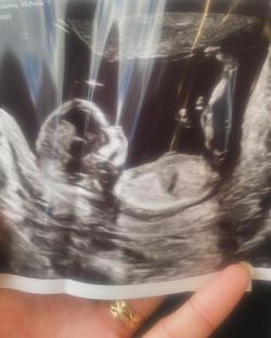 Ultrasound image of a fetus.