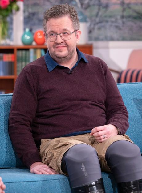 Vascular surgeon Neil Hopper on a TV show, wearing prosthetic legs.