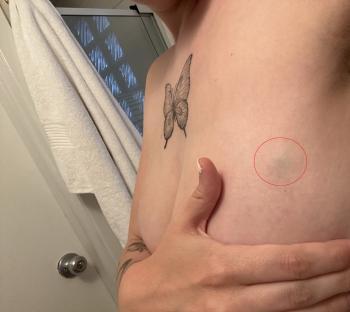 Close-up photo of a lump on a woman's chest.