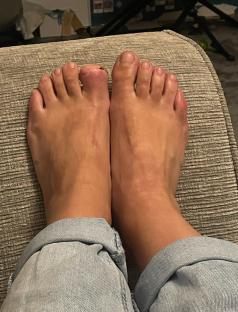 Photo of a woman's feet, showing a damaged toenail that was a symptom of acral lentiginous melanoma.