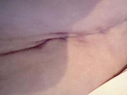 Close-up photo of a surgical scar on a woman's abdomen.