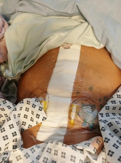 Patient's bandaged abdomen with an IV line, after surgery to remove uterus, part of the bowel, and appendix due to stage three ovarian cancer.
