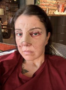 Close-up of a woman's face post-eyelid and nose surgery.