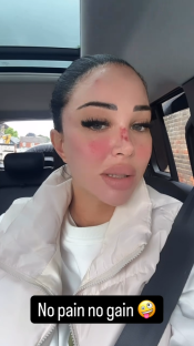 Woman in car with facial bruising, caption: