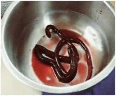 Giant kidney worm in a metal bowl with blood.