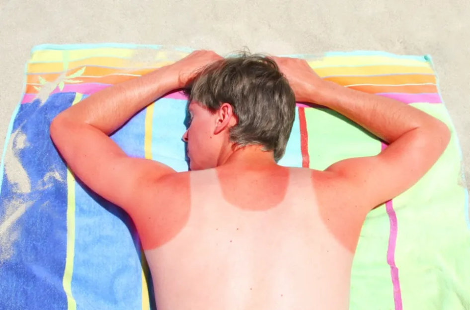 Person severely sunburned lying on a beach towel.
