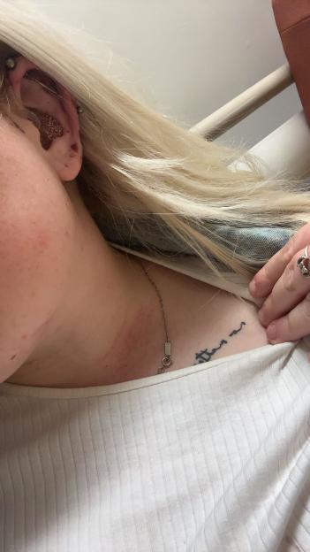 Photo of a woman's neck and shoulder showing bruises and a small tattoo.