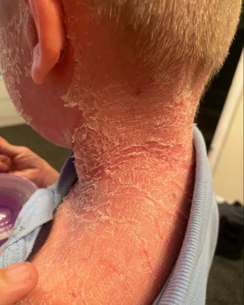 The neck and upper back of a person with very dry, flaky, red skin from ichthyosis.