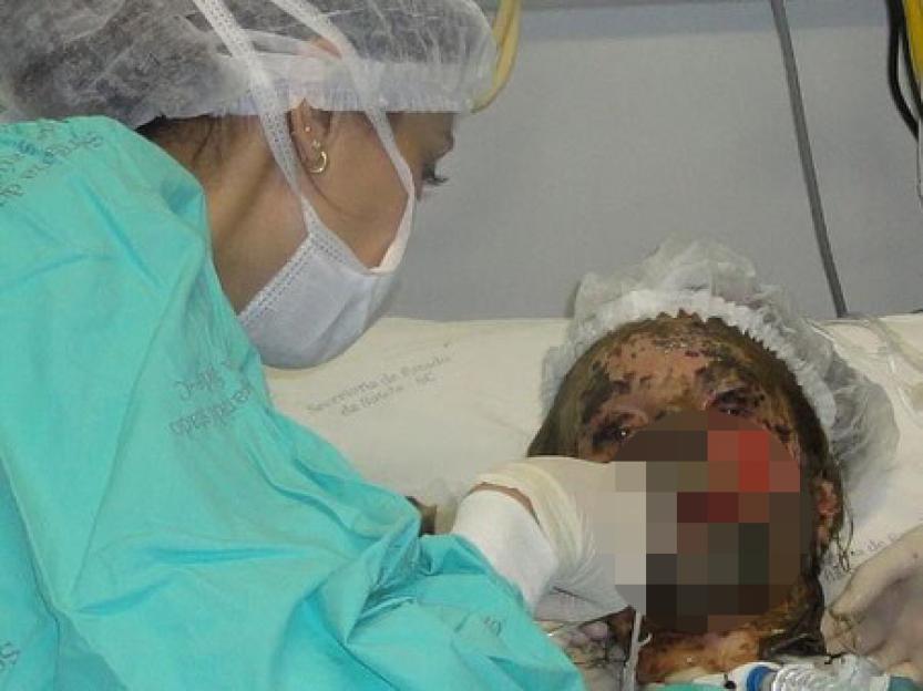 A woman with severe burns receives medical attention in a hospital bed.
