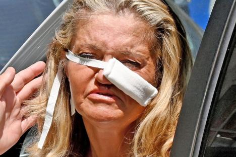 Danniella Westbrook seen in bandages after surgeons use cartilage from her rib to fix her nose in life changing op