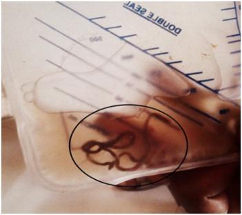 Giant kidney worm (Dioctophyma renale) in a urine sample.