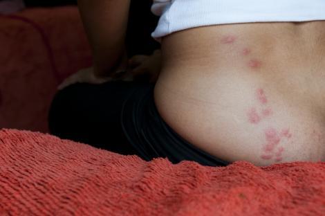 Close-up photo of itchy bed bug bites on a woman's lower back and buttocks.