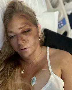 Woman in hospital bed with facial injuries.