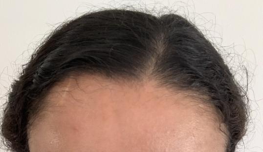 Close-up of a person's hairline.