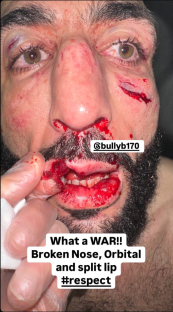 Close-up photo of a man's severely injured face showing a broken nose, orbital injury, and split lip.