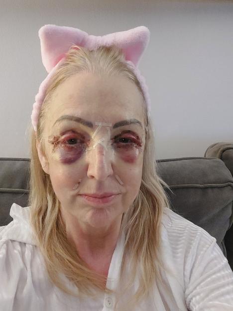 Dot Marr recovering from eye bag surgery, with significant bruising and bandages around her eyes and nose, wearing a pink bow headband.