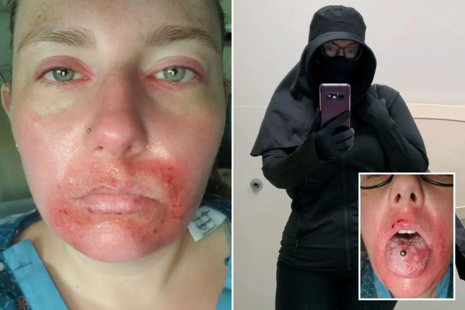 Stunning Images of 'Real-Life Vampire' with Skin That Oozes Fluid from Third-Degree Burns After Moments in the Sun