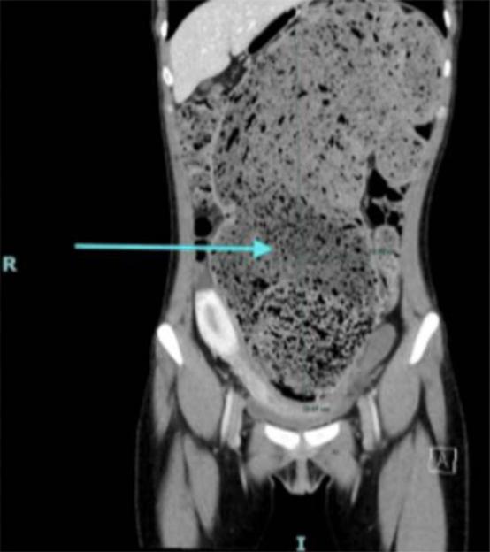 CT scan showing massively distended colon.
