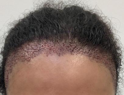 Hair transplant results.
