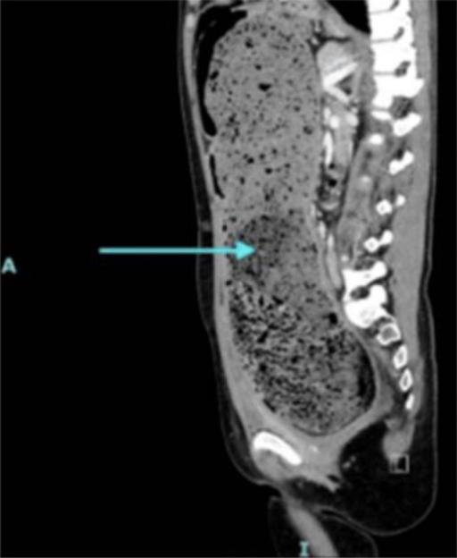 Sagittal CT scan showing massively distended colon.