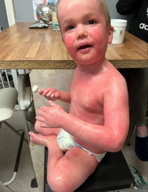 Caiden, a toddler with congenital ichthyosis, has red and inflamed skin, and is holding a small white lollipop.