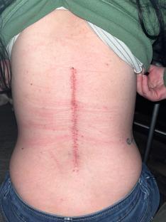 Woman's back with spinal surgery scar.