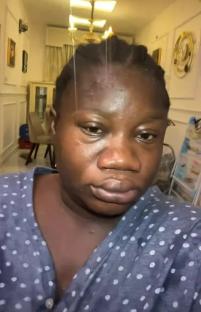 Close-up of a woman's face showing changes during pregnancy.