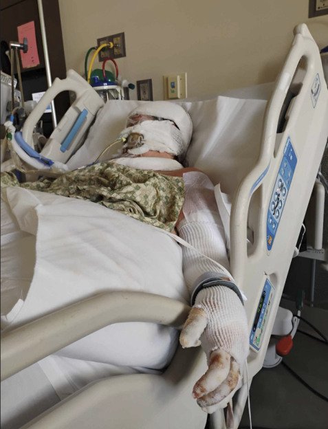 Stephanie Bell in a hospital bed with her head and hands heavily bandaged due to severe burns.