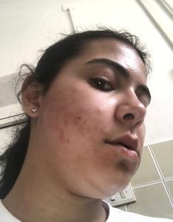 Close-up of a woman's face showing a rash.