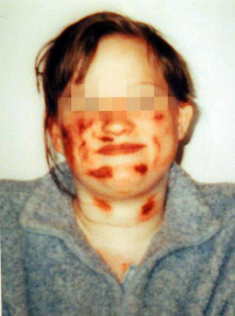 Injuries on the face and neck of a child victim of abuse, with face pixelated for privacy.