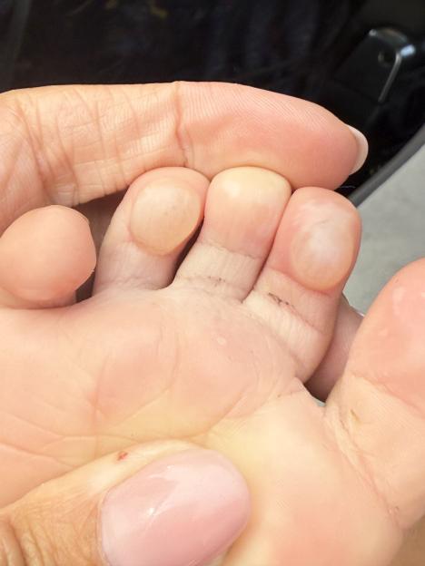 Close-up of a toddler's foot with blisters on the toes.