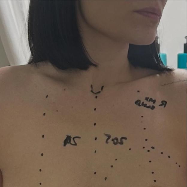 Close-up of a person's chest with markings indicating surgery for breast cancer.