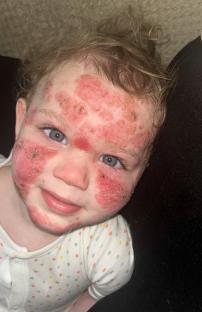 Toddler with severe eczema.