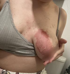 Burn on a woman's breast from a baby bottle exploding.