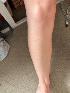 Close-up of a leg with irritated skin after trying five different hair removal methods.
