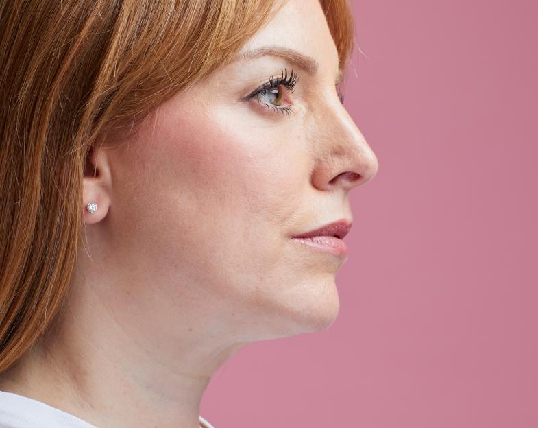 Profile of writer Beth King after jowl removal treatment.